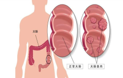 腸息肉會(huì)癌變嗎？腸鏡檢查出腸息肉千萬(wàn)別大意！