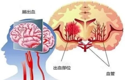 原來高血壓和腦出血有這樣的關(guān)系......高血壓別不當(dāng)回事，警惕變成腦出血！