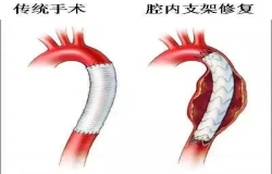 《問(wèn)心》熱播！全網(wǎng)熱議的主動(dòng)脈夾層，您了解嗎？
