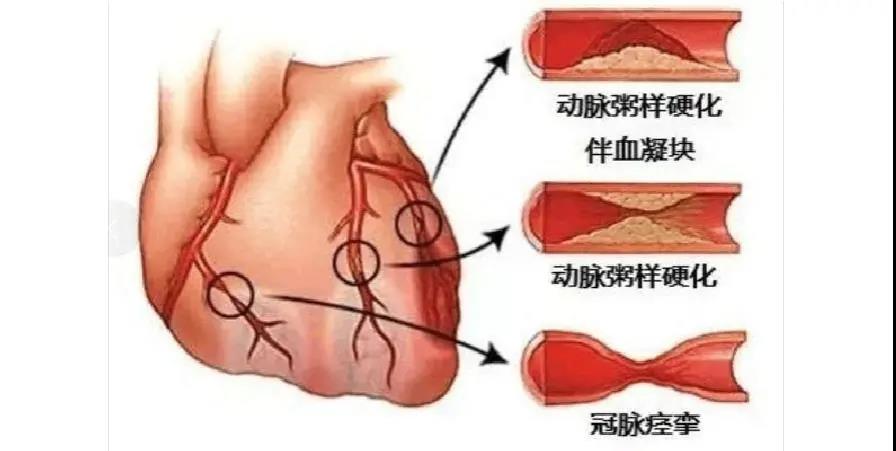 冠心病患者注意了，專業(yè)醫(yī)生為您盤點那些堅決不能停的藥！