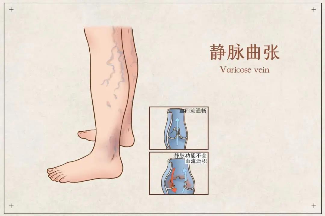 爬上腿的“蚯蚓”：靜脈曲張了怎么辦？