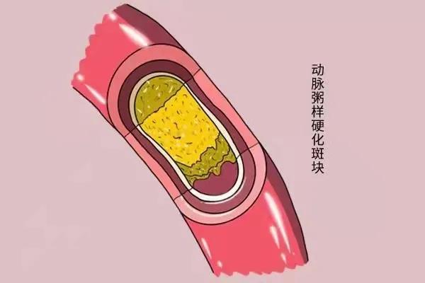 他汀類藥物有什么副作用？聽專家說......